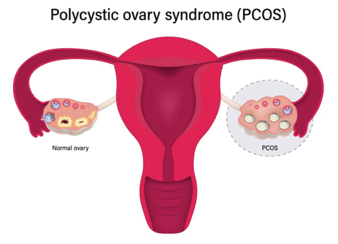 PCOS: Know About the Symptoms, Treatments, and Weight Management – Your Proper Guide to Managing Polycystic Ovary Syndrome