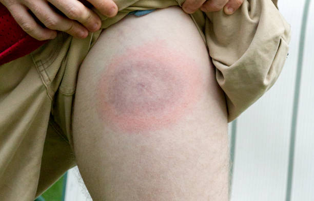 Chronic Lyme Disease – What We Know Now