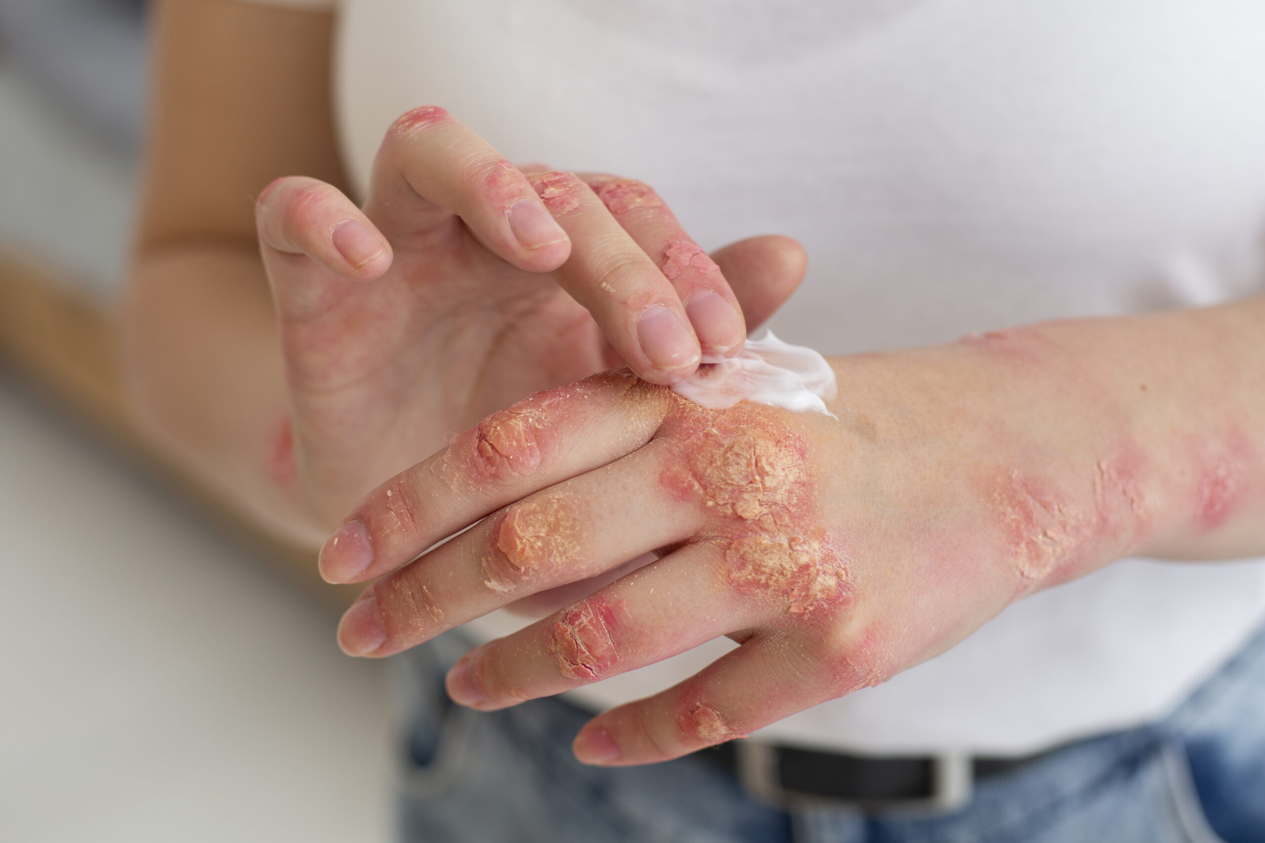 Hidradenitis Suppurativa – Misdiagnosed, Painful Skin Disease