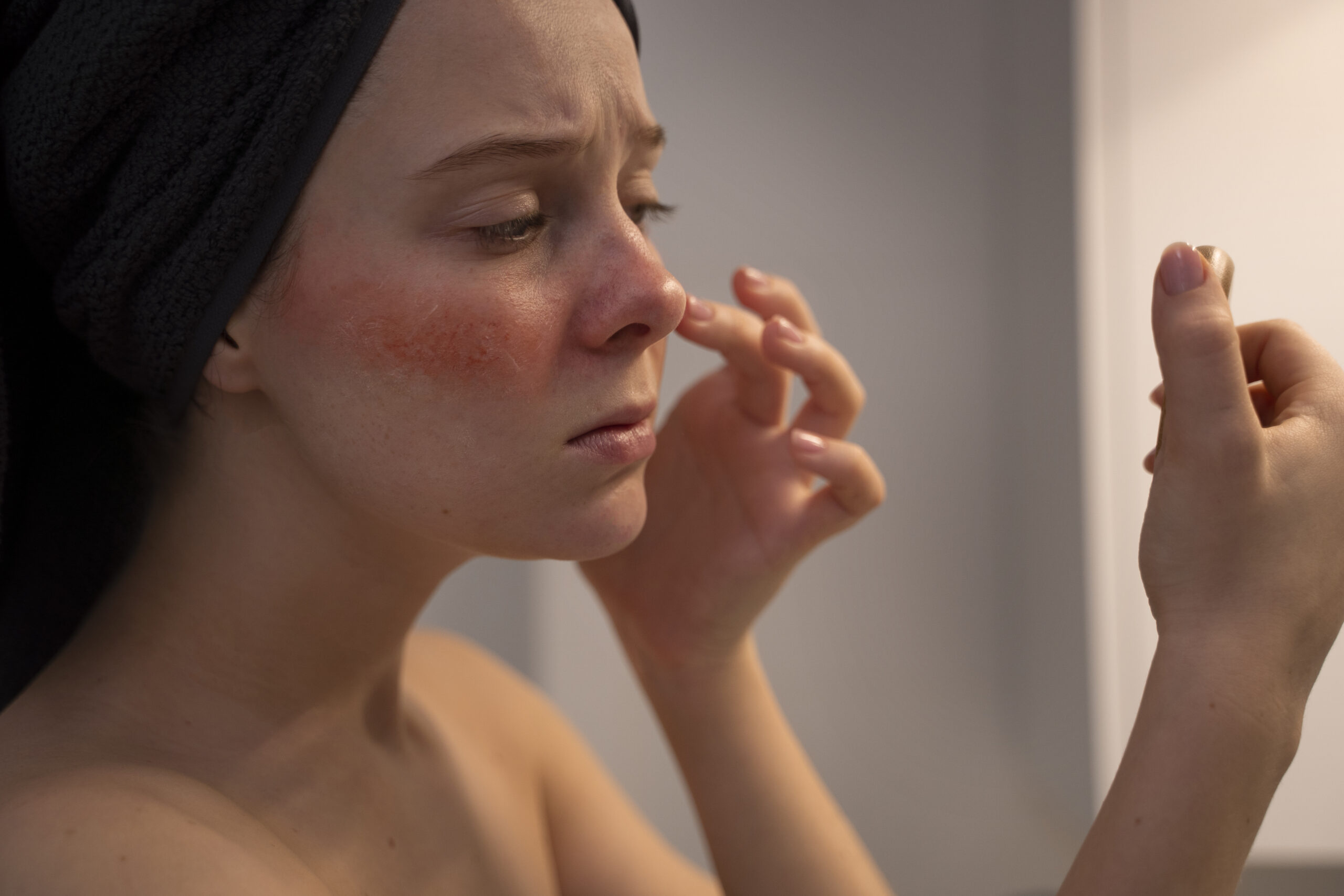 Lichen Planus – Oral, Genital and Skin Presentations