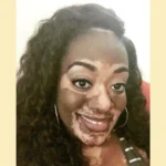 Vitiligo Patient Story: Embracing Skin, Reclaiming Confidence