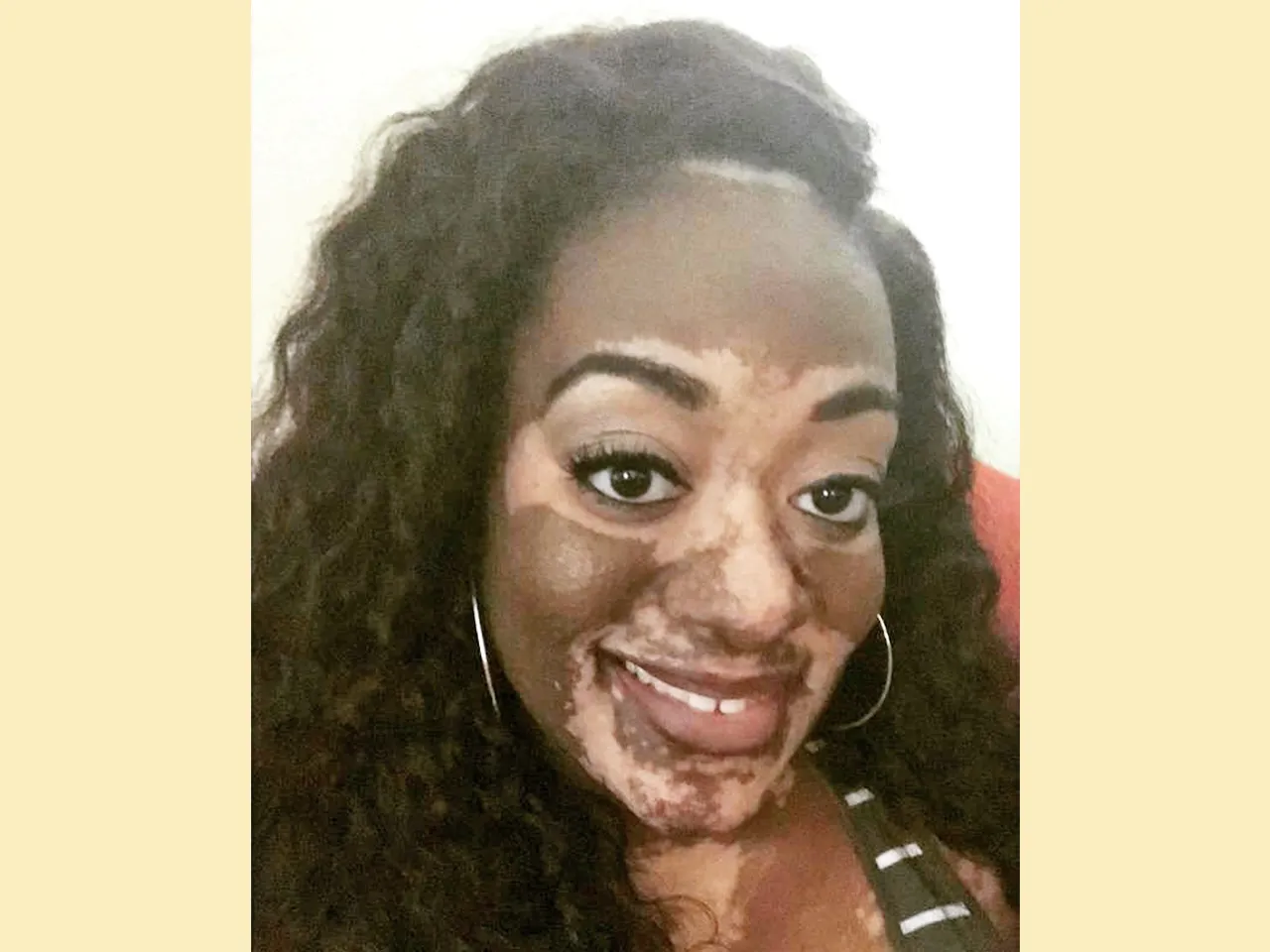 Vitiligo Patient Story: Embracing Skin, Reclaiming Confidence