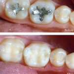 Mercury Fillings Removal: Is It Worth It?